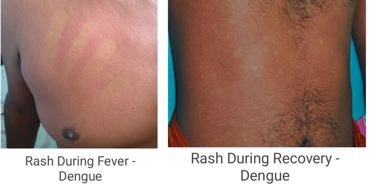 Dengue Rash